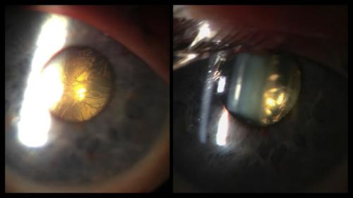 Cataract - gas - after pars plana vitrectomy